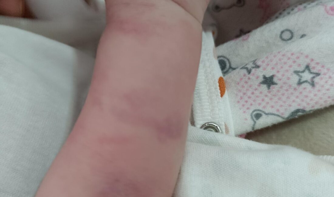 Antalya'da yaşayan 32 yaşındaki Osman Vesek, 1 yaşındaki kızının vücudunda