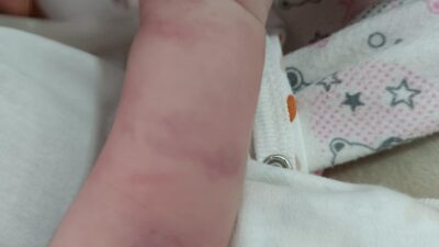 Antalya'da yaşayan 32 yaşındaki Osman Vesek, 1 yaşındaki kızının vücudunda